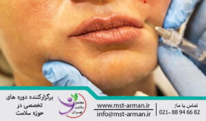 nasolabial area | ناحیه نازولبیال