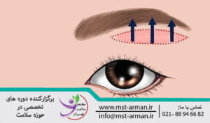 Eyebrow lift is a simple fixing method | لیفت ابرو روش فیکس کردن ساده 
