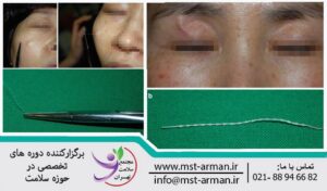 thread protrusion | بیرون زدگی نخ