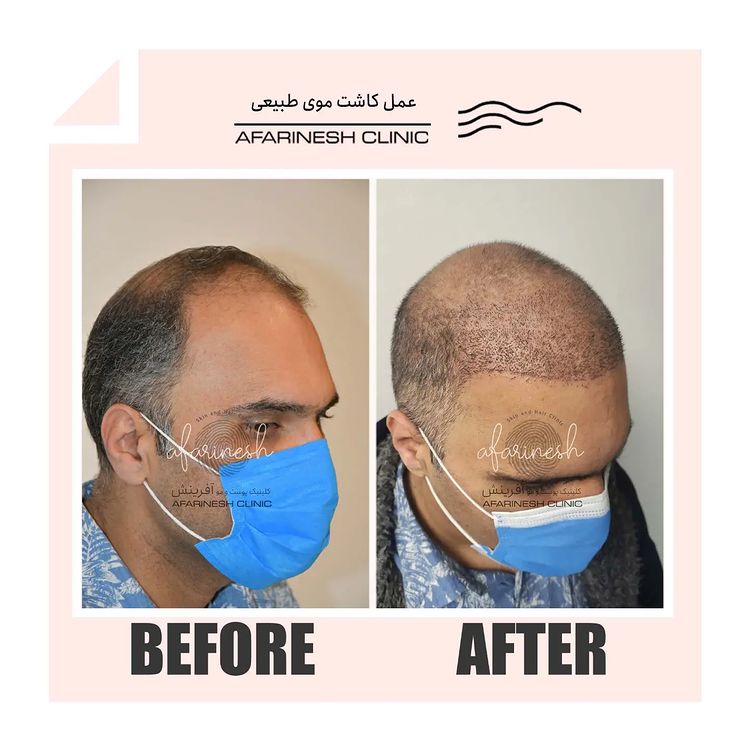 کاشت طبیعی مو آفرینش | hair transplant