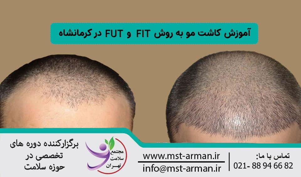 آموزش انواع روش كاشت مو در کرمانشاه