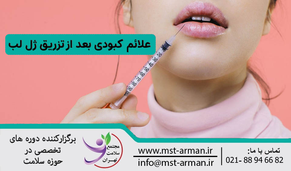 علائم کبودی بعد تزریق ژل لب