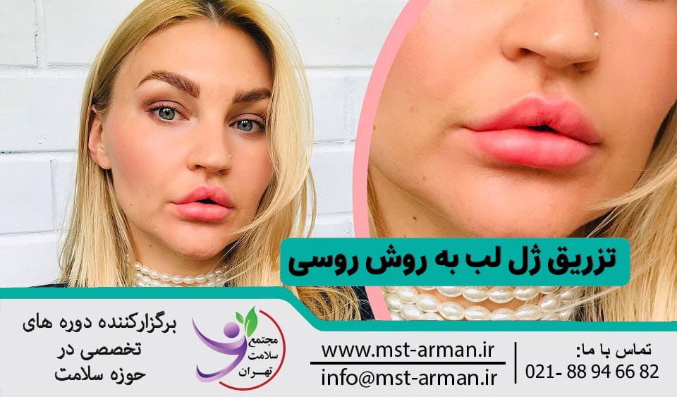 تزریق ژل لب روسی