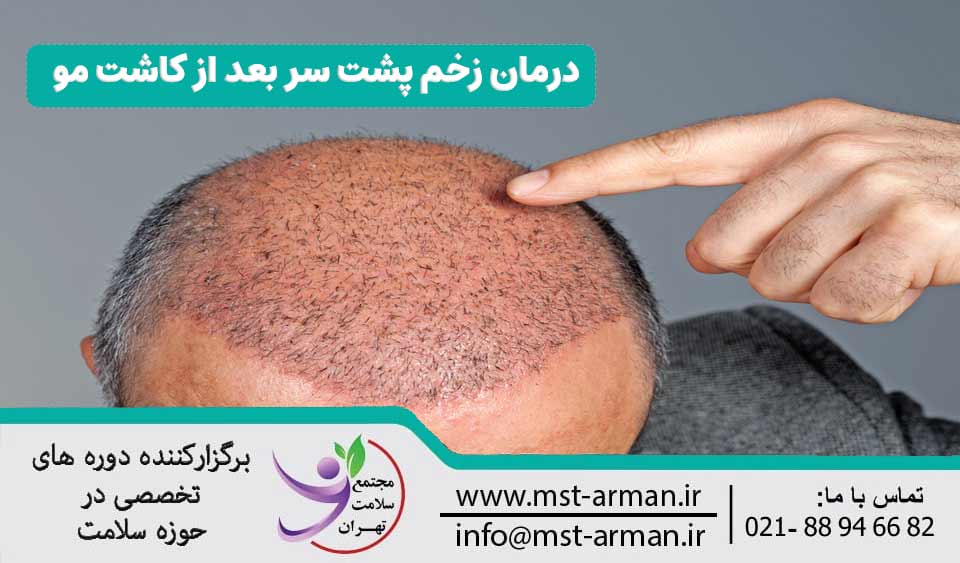 درمان زخم پشت سر بعد از کاشت مو
