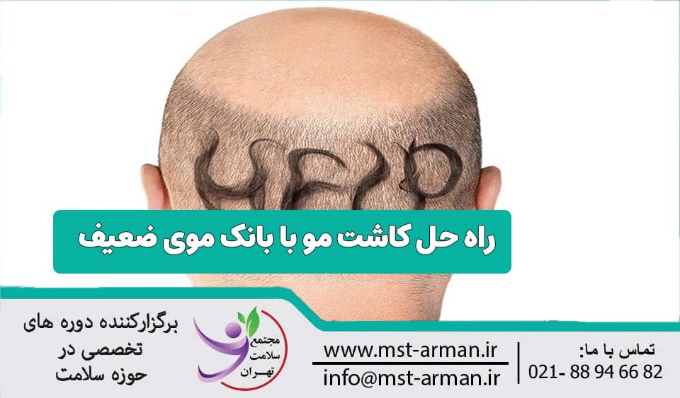 کاشت مو با بانک موی ضعیف