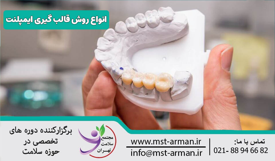 روش قالب گیری ایمپلنت