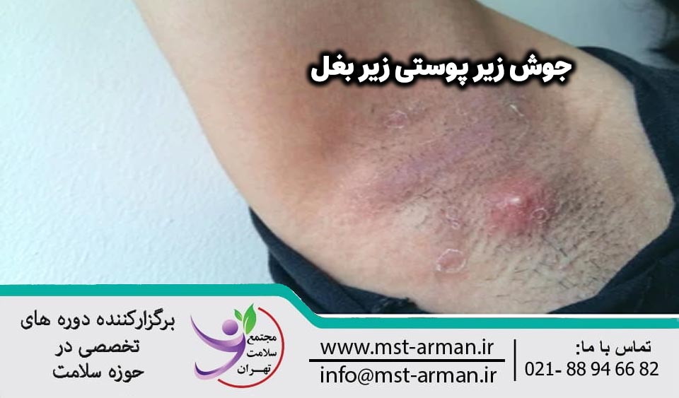 تصویر جوش زیر پوستی زیر بغل