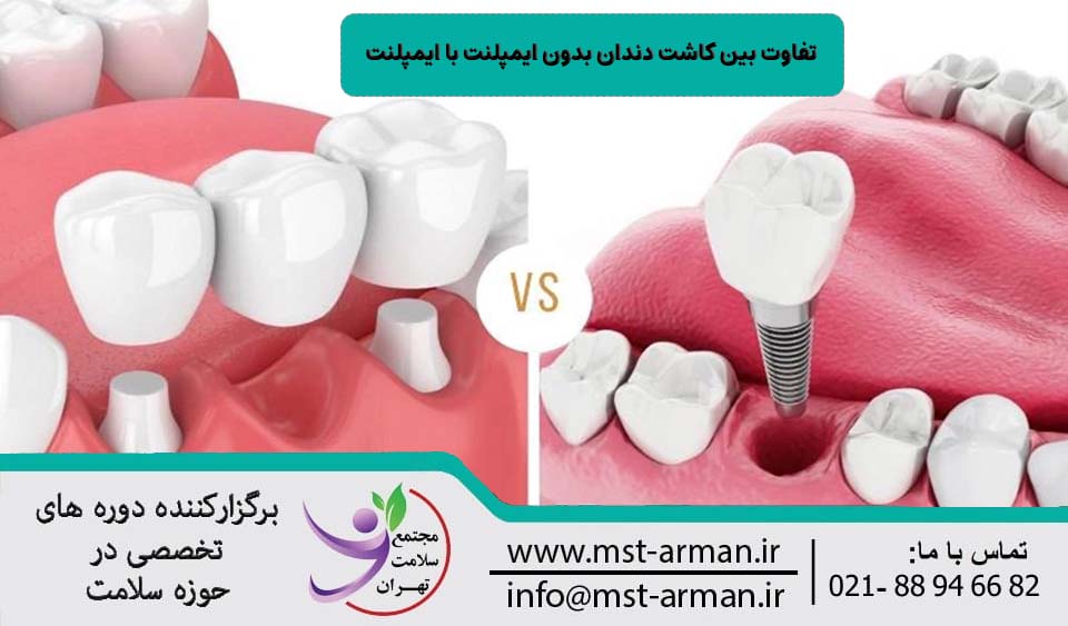 تفاوت کاشت دندان بدون ایمپلنت با ایمپلنت