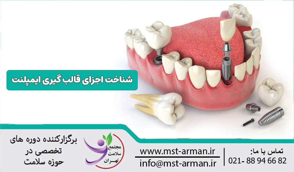 اجزای قالب گیری ایمپلنت
