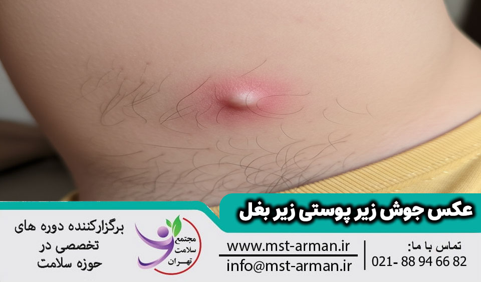 عکس جوش زیر بغل
