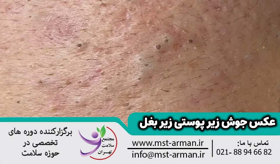 عکس جوش زیر پوستی زیر بغل