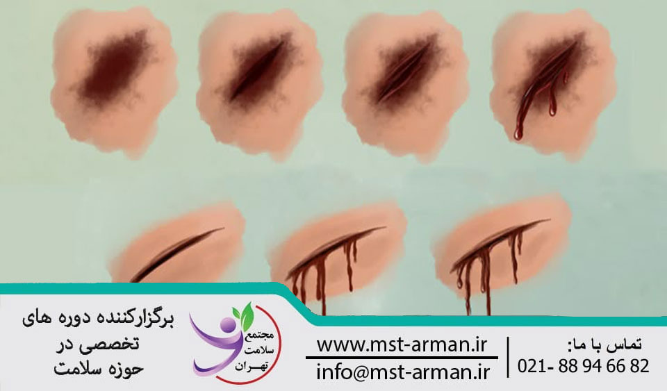 تفاوت خون خشک شده با زخم