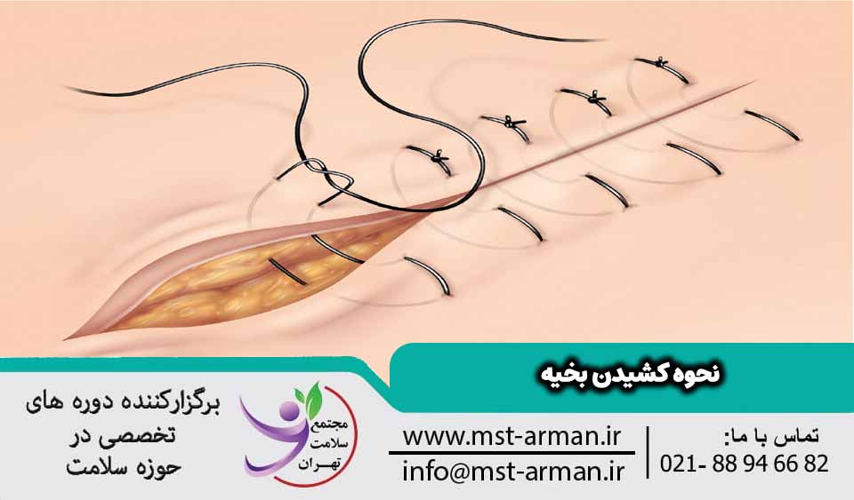 نحوه کشیدن بخیه