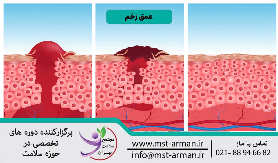 عمق زخم