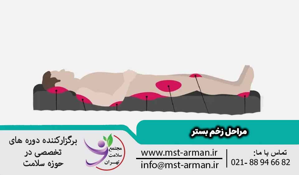 مراحل زخم بستر