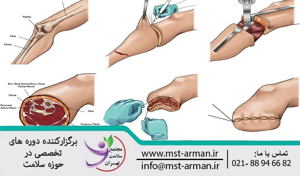 درمان سریع زخم قطع عضو