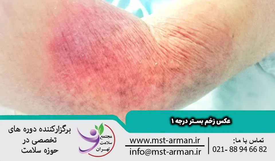 عکس زخم بستر درجه 1