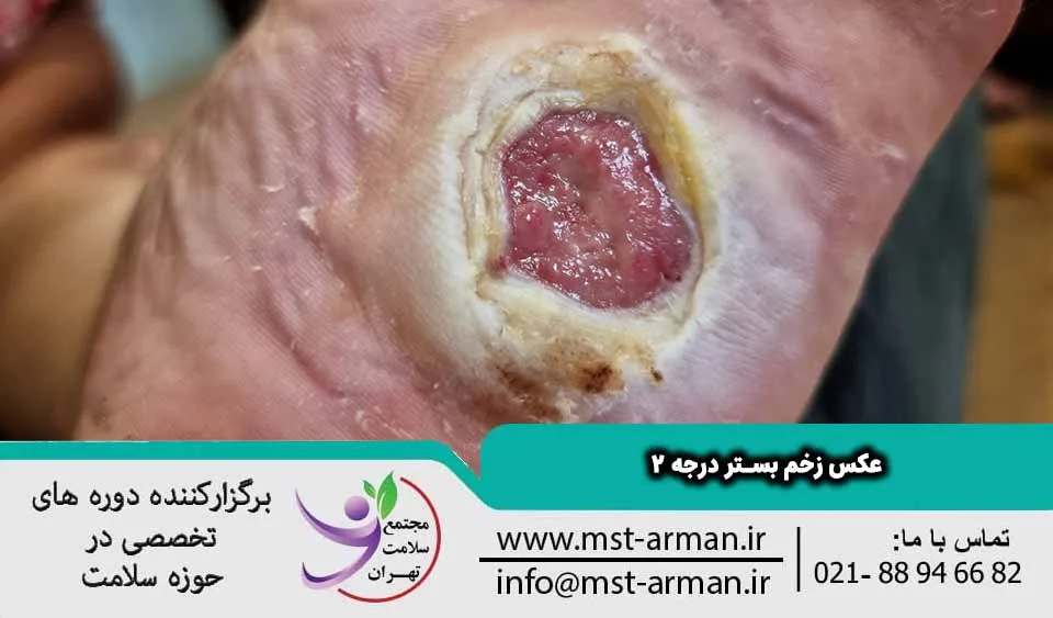 عکس زخم بستر درجه 2
