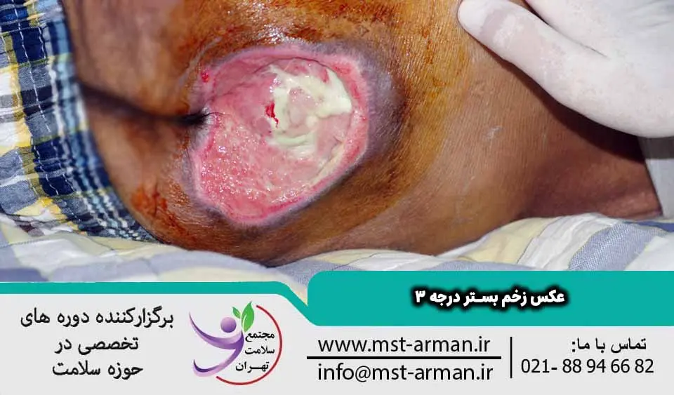 عکس زخم بستر درجه 3