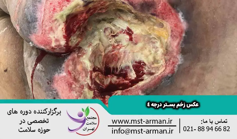 عکس زخم بستر درجه 4