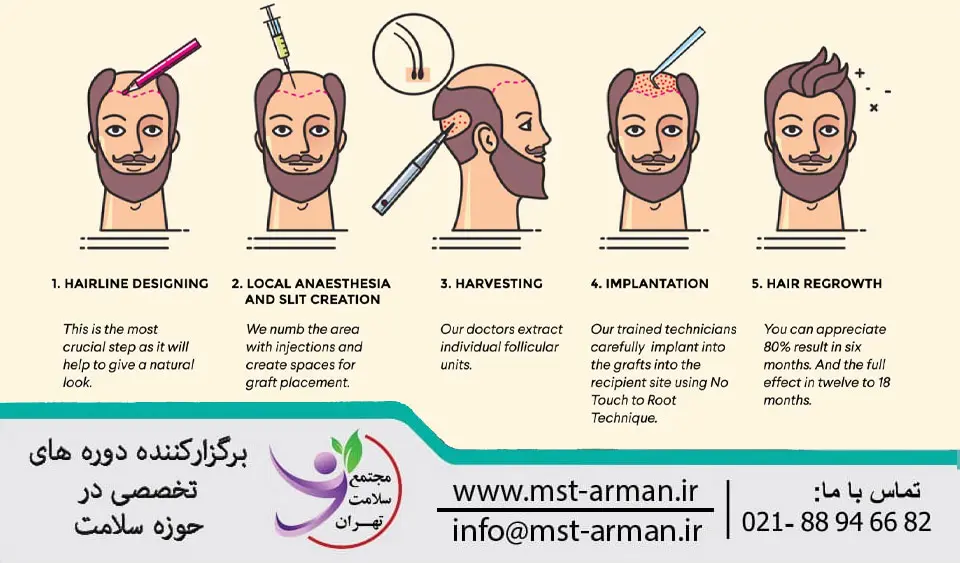 مراحل کاشت مو چگونه است
